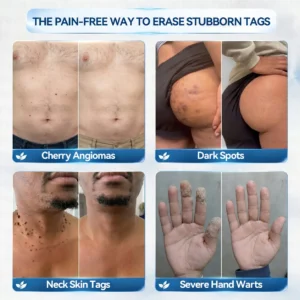 𝐏𝑖𝐜𝐝𝑜® 7-𝐷𝑎𝑦 𝑇𝑎𝑔 & 𝑆𝑝𝑜𝑡 𝑅𝑒𝑚𝑜𝑣𝑒𝑟 𝑆𝑝𝑟𝑎𝑦(Zero Pain, Zero 𝐒𝐜𝐚𝒓𝒔 Precision Spray)🍁