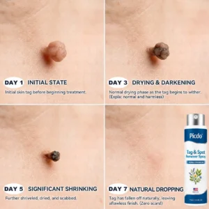 𝐏𝑖𝐜𝐝𝑜® 7-𝐷𝑎𝑦 𝑇𝑎𝑔 & 𝑆𝑝𝑜𝑡 𝑅𝑒𝑚𝑜𝑣𝑒𝑟 𝑆𝑝𝑟𝑎𝑦(Zero Pain, Zero 𝐒𝐜𝐚𝒓𝒔 Precision Spray)🍁
