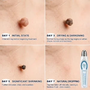 📢𝐏i𝐜𝐝o® 7-𝐷𝑎𝑦 𝗧𝐚𝐠 & 𝗦𝗽𝐨𝐭 𝐄𝐫𝒂𝒔𝒆𝒓(Zero Pain, Zero 𝐒𝐜𝐚𝒓𝒔 Rollerball)
 – healthylivingmedicalcenter