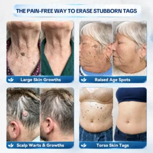 🍀𝐏𝐢𝐜𝐝𝐨® 7-𝐃𝐚𝐲 𝐒𝐤𝐢𝐧 𝐓𝐚𝐠 & 𝐒𝐩𝐨𝐭 𝐄𝐫𝐚𝐬𝐞𝐫 𝐂𝐫𝐞𝐚𝐦🩵 (Zero Pain, Zero 𝐒𝐜𝐚𝐫𝐬 For
 – Corvionx