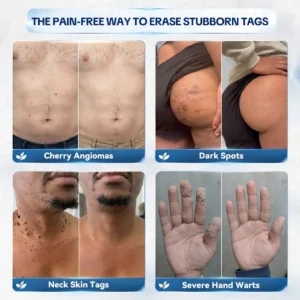 🍀𝐏𝐢𝐜𝐝𝐨® 7-𝐃𝐚𝐲 𝐒𝐤𝐢𝐧 𝐓𝐚𝐠 & 𝐒𝐩𝐨𝐭 𝐄𝐫𝐚𝐬𝐞𝐫 𝐂𝐫𝐞𝐚𝐦🩵 (Zero Pain, Zero 𝐒𝐜𝐚𝐫𝐬 For
 – Corvionx