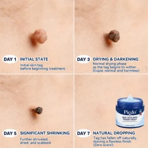 🍀𝐏𝐢𝐜𝐝𝐨® 7-𝐃𝐚𝐲 𝐒𝐤𝐢𝐧 𝐓𝐚𝐠 & 𝐒𝐩𝐨𝐭 𝐄𝐫𝐚𝐬𝐞𝐫 𝐂𝐫𝐞𝐚𝐦🩵 (Zero Pain, Zero 𝐒𝐜𝐚𝐫𝐬 For
 – Corvionx